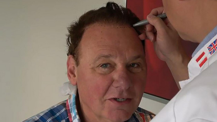 Jan-de-Hoop-hair transplant